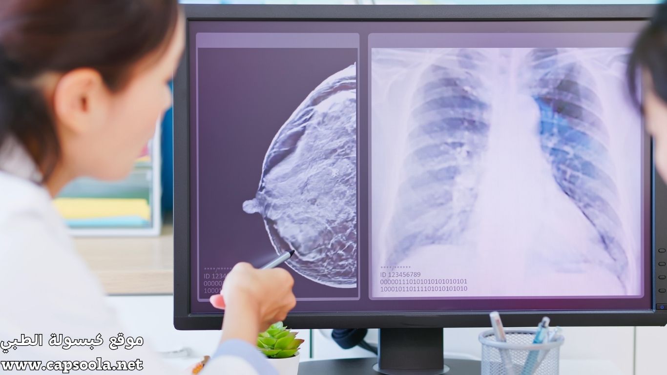 سرطان الثدي الالتهابي (Inflammatory Breast Cancer): الأعراض، الأسباب، والعلاج الحديث 2025