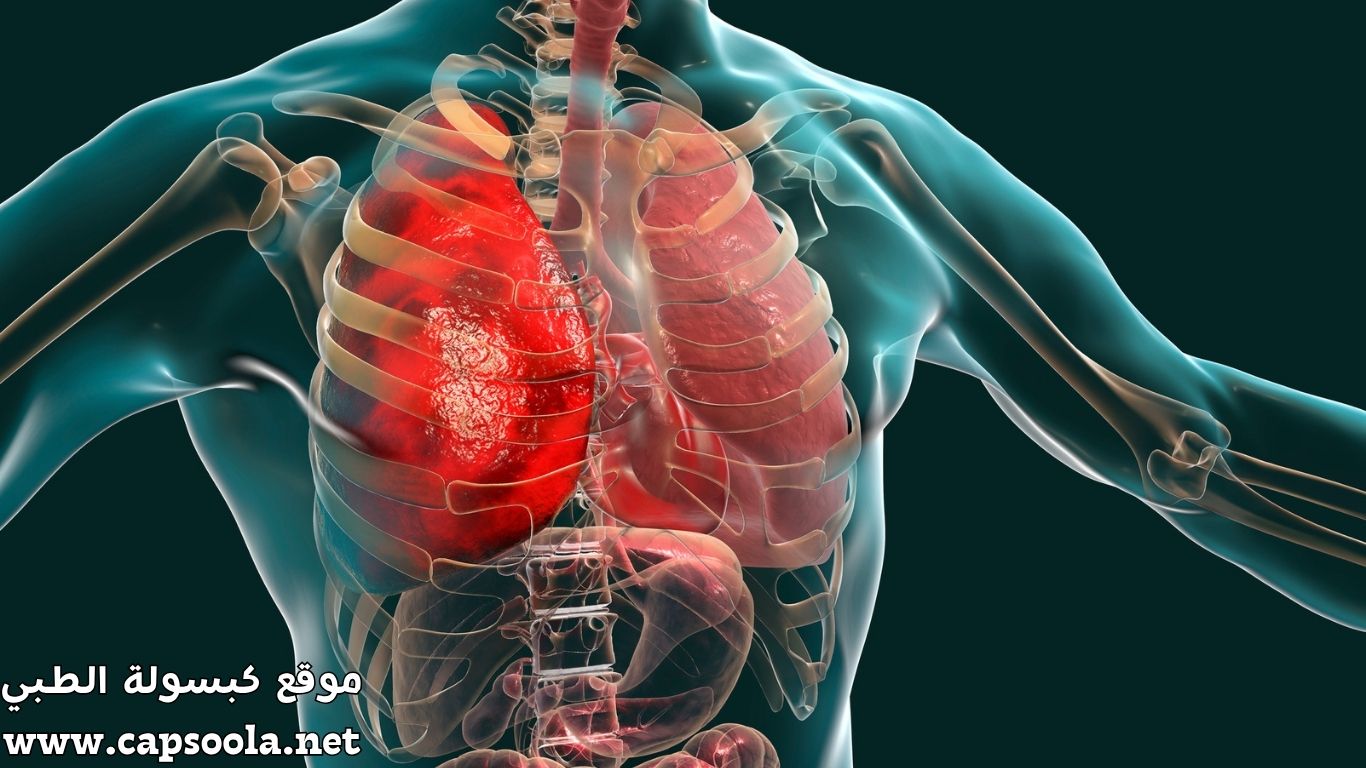 التهاب الشعب الهوائية: كل ما تحتاج معرفته عن الأعراض والعلاج والوقاية
